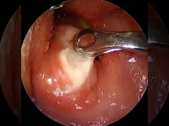 Corriente ≤ 1,5 mA Artroscopia RF Varita de plasma Equipos quirúrgicos Hombre Cadera Rodilla