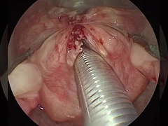 Corriente ≤ 1,5 mA Artroscopia RF Varita de plasma Equipos quirúrgicos Hombre Cadera Rodilla